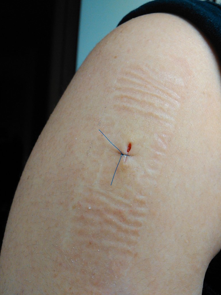 Day after sun spot removal. Pretty neat little wound. And to think I was so nervous for that.